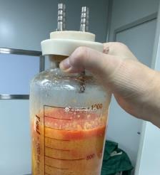 信阳水动力吸脂手术要做多久？